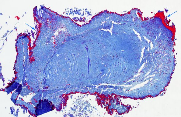 5C1 Cysticercosis, degenerated (Case 5) Trichrome 5 copy