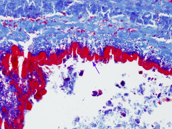 5C2 Cysticercosis, degenerated (Case 5) Trichrome 1