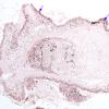 5C3 Cysticercosis, degenerated (Case 5) Von Kossa (Ca) 2 A