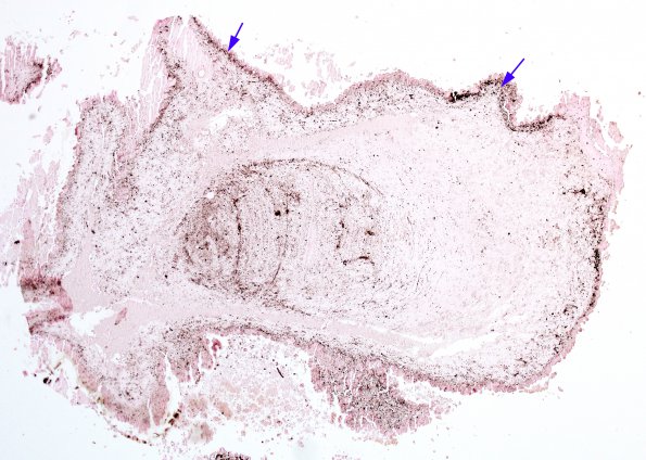 5C3 Cysticercosis, degenerated (Case 5) Von Kossa (Ca) 2 A