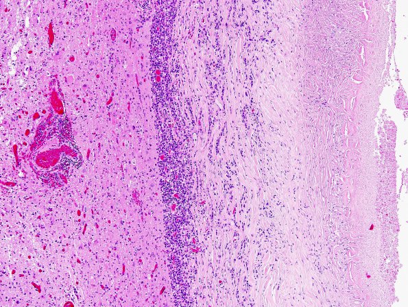 6 Cysticercosis (Case 6) 2