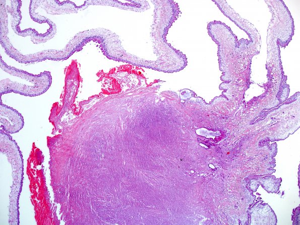 7A2 Cysticercosis (Case 7) H&E 6A