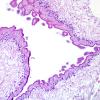 7A3 Cysticercosis (Case 7) H&E 1