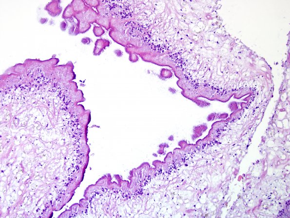 7A3 Cysticercosis (Case 7) H&E 1