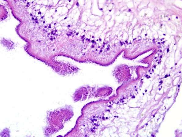 7A4 Cysticercosis (Case 7) H&E 3