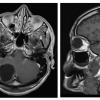 9A Neurocysticercosis, racemose (AANP DSS 2018 case 11) MRI