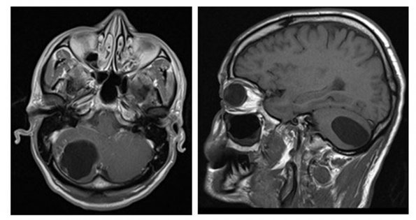 9A Neurocysticercosis, racemose (AANP DSS 2018 case 11) MRI