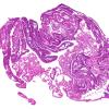 9B Neurocysticercosis, racemose (AANP DSS 2018 case 11) 1.3X