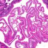 9C Neurocysticercosis, racemose (AANP DSS 2018 case 11) 5.9X