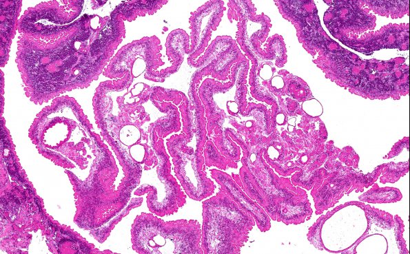 9C Neurocysticercosis, racemose (AANP DSS 2018 case 11) 5.9X