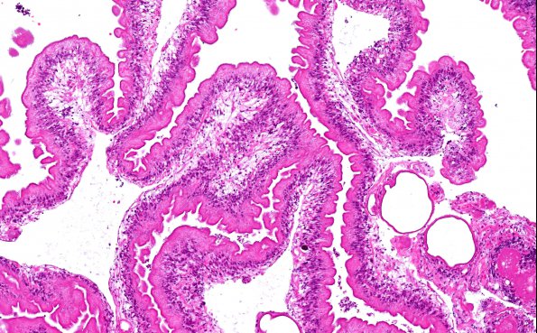 9D Neurocysticercosis, racemose (AANP DSS 2018 case 11) 17X