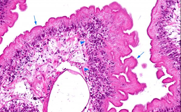 9E Neurocysticercosis, racemose (AANP DSS 2018 case 11) 40X copy