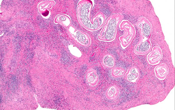 1A1 Onchocerciasis, spinal subdural mass (AANP 2016 - Case 10) 4X