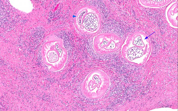 1A2 Onchocerciasis, spinal subdural mass (AANP 2016 - Case 10) 8X