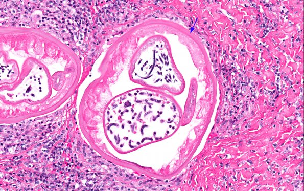 1A3 Onchocerciasis, spinal subdural mass (AANP 2016 - Case 10) 22X