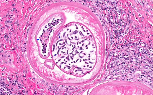 1A4 Onchocerciasis, spinal subdural mass (AANP 2016 - Case 10) 27X