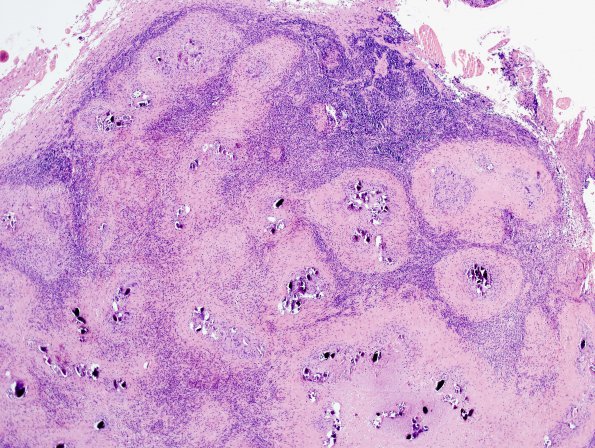 1B1 Schistosomiasis haematobia, cerebrum (Case 1) H&E 2A