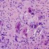 1B2 Schistosomiasis haematobia, cerebrum (Case 1) H&E 4