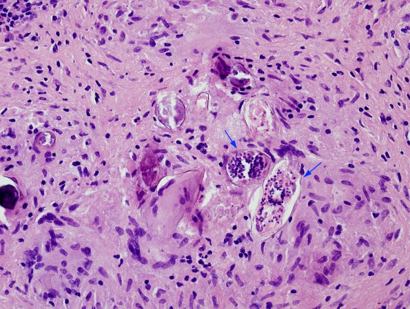 1B2 Schistosomiasis haematobia, cerebrum (Case 1) H&E 4