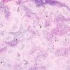 1B3 Schistosomiasis haematobia, cerebrum (Case 1) H&E 12A