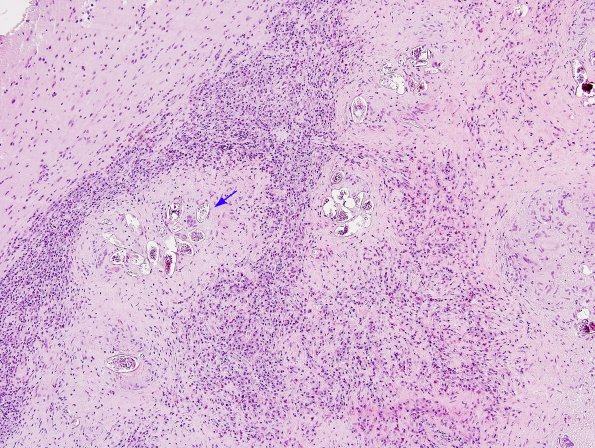 1B4 Schistosomiasis haematobia, cerebrum (Case 1) H&E 14