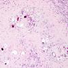 1B5 Schistosomiasis haematobia, cerebrum (Case 1) H&E 15A