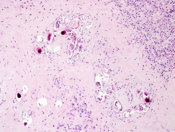 1B5 Schistosomiasis haematobia, cerebrum (Case 1) H&E 15A