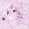 1B6 Schistosomiasis haematobia, cerebrum (Case 1) H&E 17 (2)A