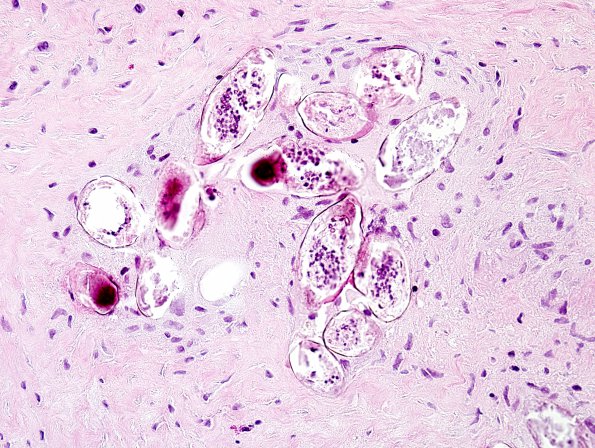 1B6 Schistosomiasis haematobia, cerebrum (Case 1) H&E 17 (2)A