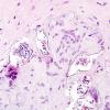 1B7 Schistosomiasis haematobia, cerebrum (Case 1) H&E 11A