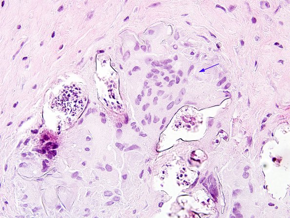 1B7 Schistosomiasis haematobia, cerebrum (Case 1) H&E 11A