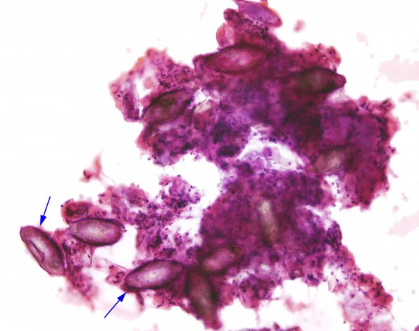 1B8 Schistosomiasis haematobia, cerebrum (Case 1) H&E 6