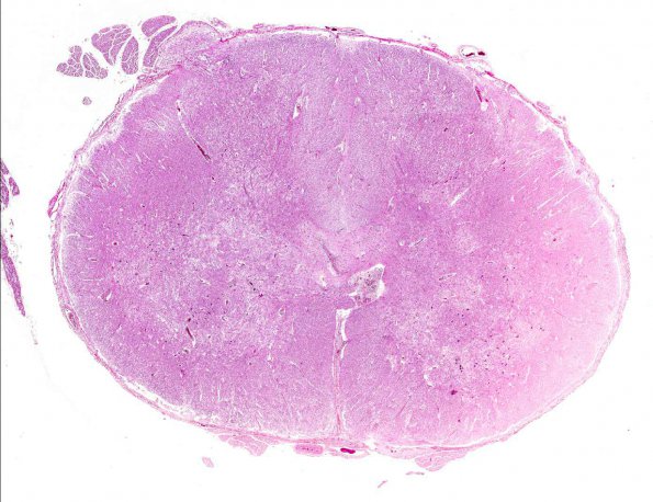 2A1 Schistosomiasis (AANP 1976, Case 1) H&E X0.9