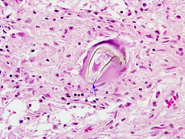 2A5 Schistosomiasis (AANP 1976-Case 1) H&E 8A