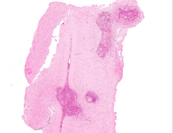 3A1 Schistosomiasis (AANP 2003 Case 9) H&E whole mountA