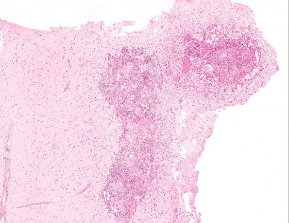 3A2 Schistosomiasis (AANP 2003 Case 9) H&E 4