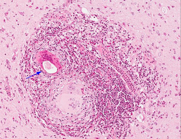 3A4 Schistosomiasis (AANP 2003 Case 9) H&E 20X 3