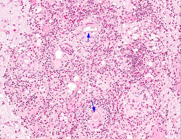 3A5 Schistosomiasis (AANP 2003 Case 9) H&E 20X 2A