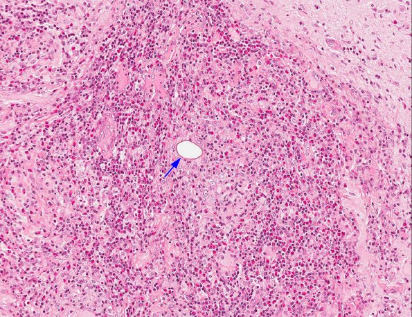 3A6 Schistosomiasis (AANP 2003 Case 9) H&E 20X 4