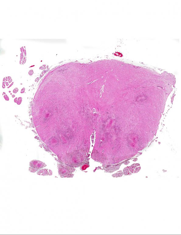 4A1 Schistosoma mansoni myelitis (AANP 1985, Case 3) H&E X0.7