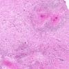 4A2 Schistosoma mansoni myelitis (AANP 1985, Case 3) H&E X4 1