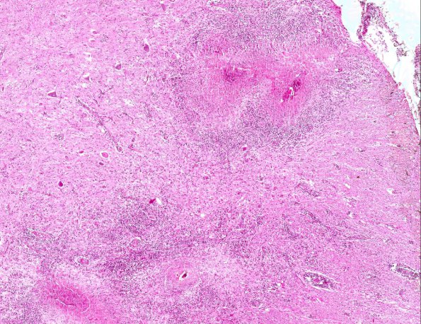 4A2 Schistosoma mansoni myelitis (AANP 1985, Case 3) H&E X4 1