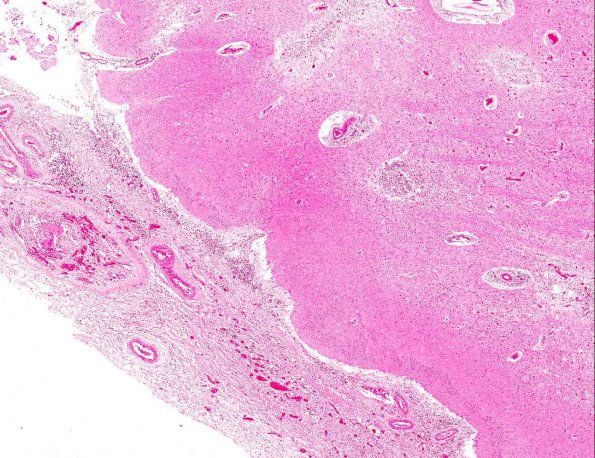 1A Lymphoplasmacytic meningoencephalitis, trematode, migration (AANP DSS 2000, Case 7, H&E 1A