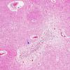 1A5 Lymphoplasmacytic meningoencephalitis, trematode, migration (Image from Virtual Slide, AANP 2000, Case 7, H&E X5 4