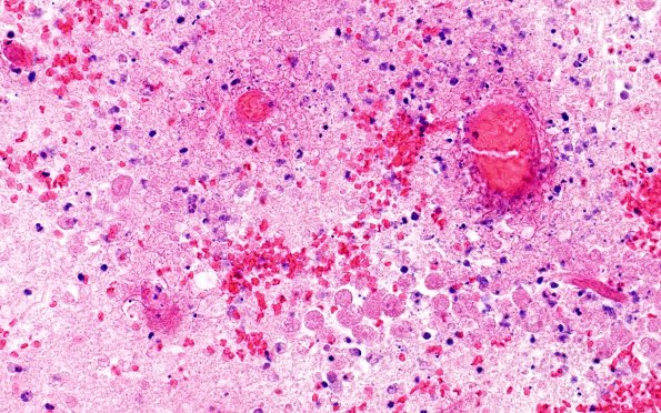 10A10 Acanthamoeba (Case10) 40X 4