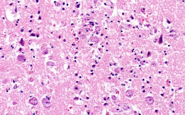 10A11 Acanthamoeba (Case10) 40X 2