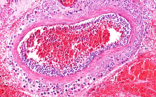 10A12 Acanthamoeba (Case10) 20X 2