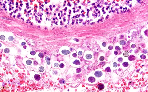 10A13 Acanthamoeba (Case10) 60X