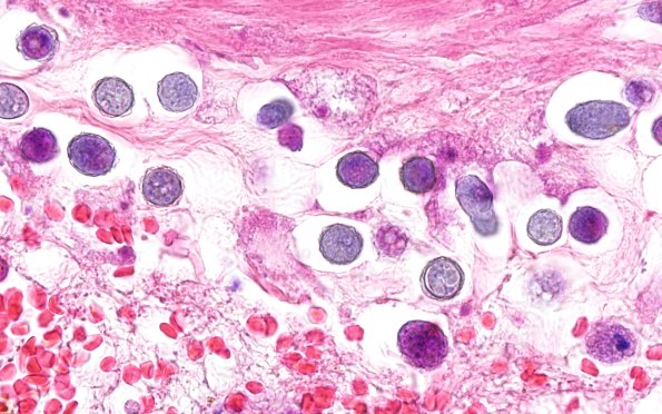 10A14 Acanthamoeba (Case10) 100X 2