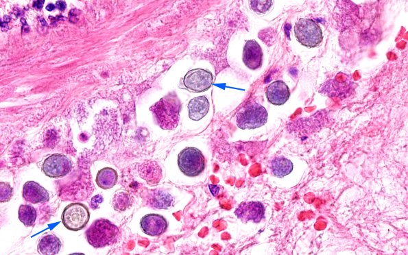 10A15 Acanthamoeba (Case10) 100X 4 copy